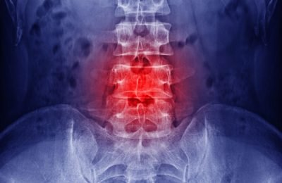 Spine X Ray Spine X Ray